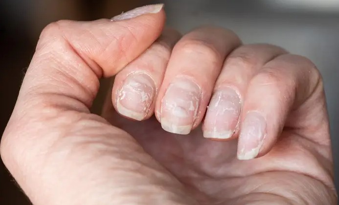 nail damage issues